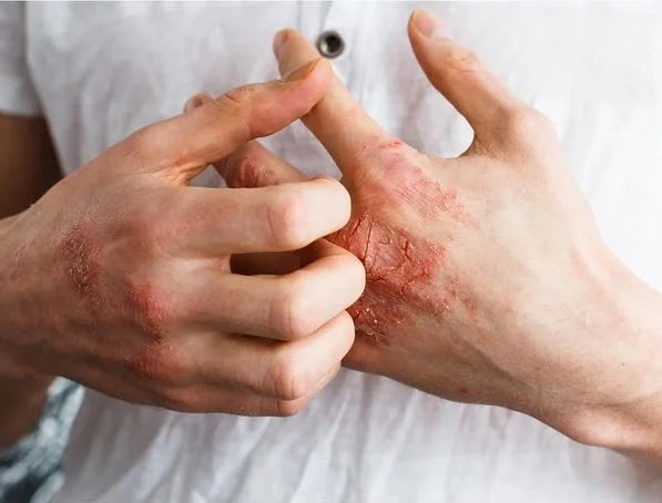 Atopik Cilt Nedir? Belirtiler, Nedenler ve Bakım