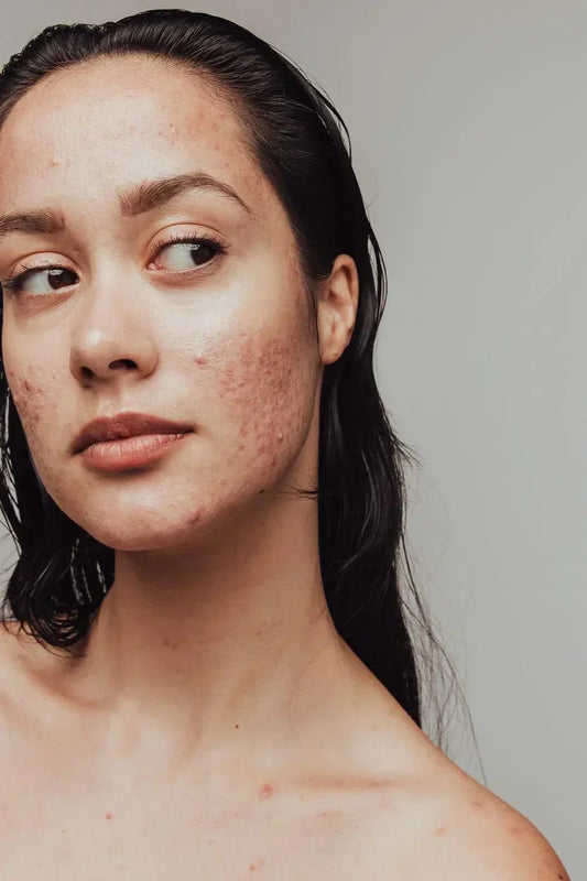 Aloe Vera, Sivilce İzlerine İyi Gelir mi? - RHANEVA